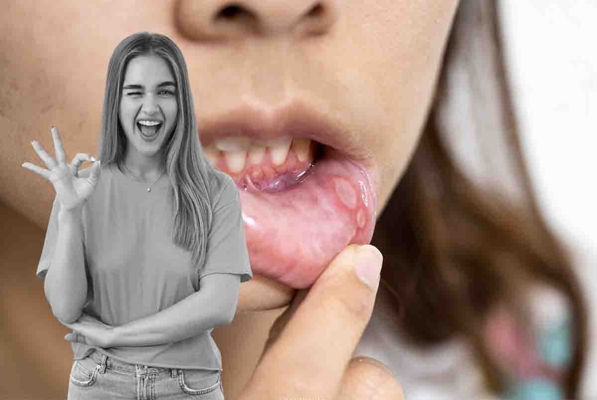 come eliminare le afte in bocca