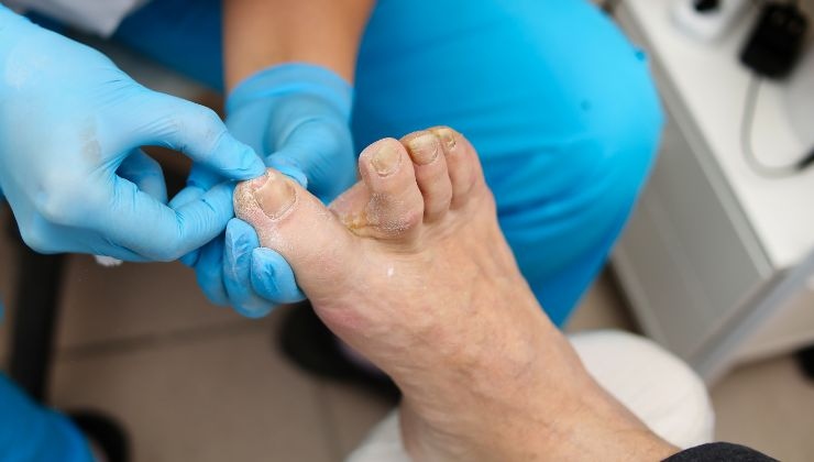 I sintomi ai piedi che ti dicono se soffri di diabete
